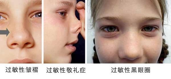 過敏性鼻炎會(huì)讓孩子變傻？！家長(zhǎng)該如何應(yīng)對(duì)